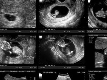 陕西试管婴儿费用攻略，让您省钱又省心