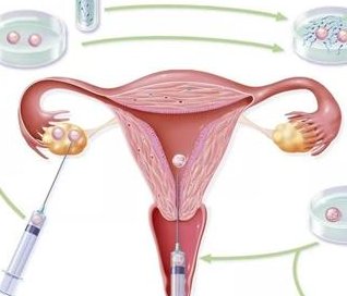 幼稚子宫做助孕成功率高吗？幼稚子宫如何提高助孕成功率